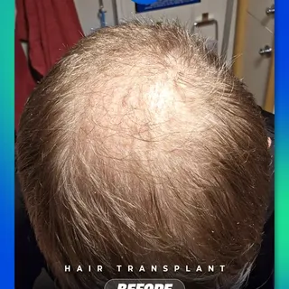 Your hair doesn't define you, but restoring it can redefine how you feel. ⭐

Swipe to see this incre