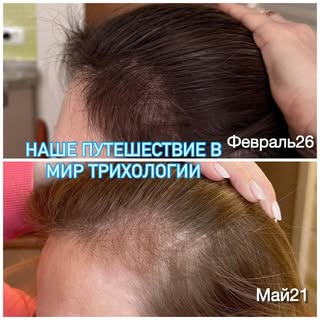 🌟 ВОССТАНОВЛЕНИЕ ВОЛОС – ЭТО ПУТЕШЕСТВИЕ, А НЕ ГОНКА!🌟

Дорогие мои пациенты! 💕

Сегодня хочу под