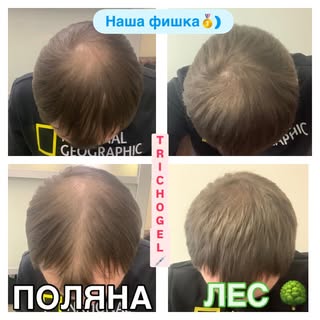 TrichoGel: как превратить «поляну» обратно в лес 🌲
Парни!!! Мужчины!! Мужики!! Давайте честно: то, 