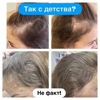 «У МЕНЯ ТАК С ДЕТСТВА»
💭 Самая опасная иллюзия в трихологии
📝 
«У меня всегда так было» 💭
Знакома