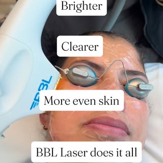 Brighter, Clearer skin starts here! Stop thinking about it.. Book your BBL Laser treatment today!
.
