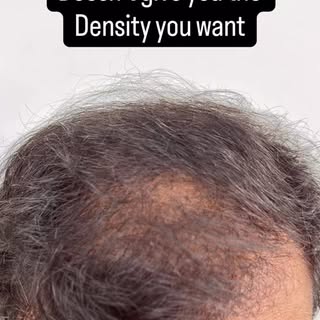 Hair transplant ✓
Density he wanted ✗

SMP fixed that.

Over multiple sessions, we added what the su