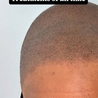 This one meant everything.
My client has been battling CCCA and androgenic alopecia for years — the 