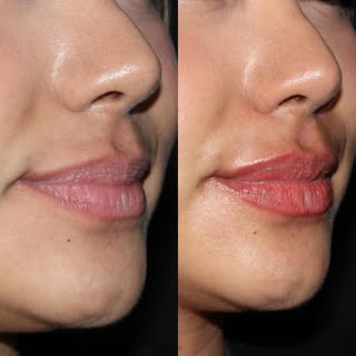 Mini lip plump 💕💋