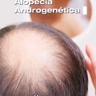 ⚠️ La pérdida de cabello no siempre ocurre de la misma manera.

La alopecia frontal fibrosante puede