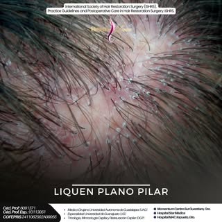 💇‍♀️🧠 ¿Por qué puede “fallar” un injerto capilar?
La realidad es que no siempre es por la técnica.