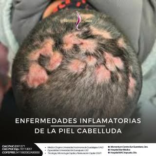 💇‍♂️✨ CUIDADOS REALES después del injerto capilar
Porque el injerto no termina el día de la cirugía