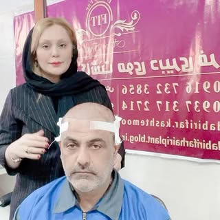 کاشت پشت سر 🙌🏻اگر بانک مو داشته باشید و با گروه حرفه‌ای با تیغ مخصوص و چیدمان مناسب کاشت انجام بشه
