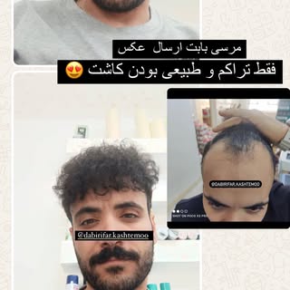 #کاشتمو #زیبایی مو #دبیریفر #حیدرشناس#اهواز #خوزستانیها_خوزستان_انديمشك_اهواز_دزفول_شوش_شوشتر_ايذه_م