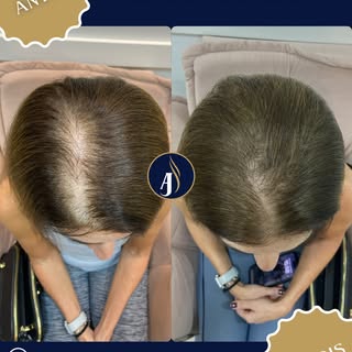 Mais um resultado de sucesso!! Entre em contato e vamos iniciar sua terapia capilar.
📲27 99782-5626