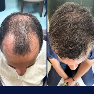 Apenas 8 meses separam essas fotos… o que está esperando pra fazer seu transplante capilar?
Agende s