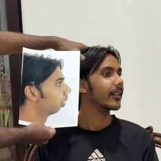 Post Ankylosis deformity patient - Transformation journey @richardsons_face_hospitals 

* #PostAnkyl