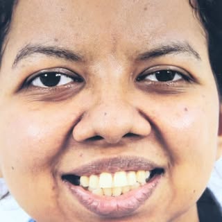 #facemakeover #osa #orthognathic #maxillofacial #jawsurgery n nose surgery