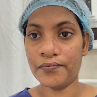 Rhinoplasty @richardsons_face_hospitals #plasticsurgery #richardsons #nosejob #rhinoplasty #plastics