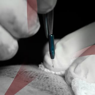 Natural-looking hair starts with perfectly designed channels 

During Sapphire FUE Hair Transplant, 
