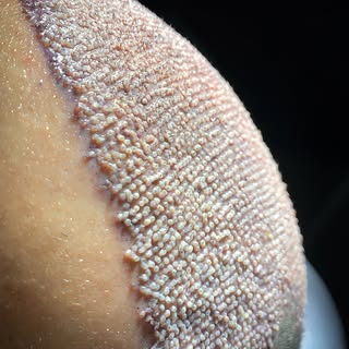 ✨ Maximum Density ✨

At Aethra Clinic, advanced hair transplant techniques deliver natural, dense, a