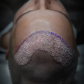 Maximum density starts with the right hairline design.

Sapphire Fue

At Aethra Clinic, every Sapphi