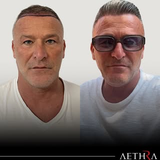 BEFORE & AFTER RESULT | AETHRA CLINIC

A naturally refined hairline and fuller appearance, achieved 