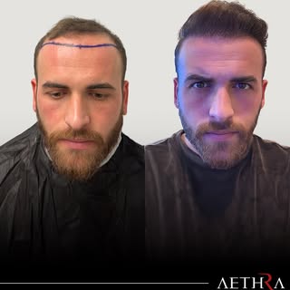 BEFORE & AFTER RESULT | AETHRA CLINIC

Doctor-performed Sapphire FUE hair transplant focused on natu
