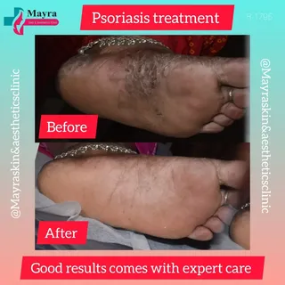 💥 *Psoriasis Breakthrough* 💥
Check out the stunning before & after of our advanced psoriasis treat
