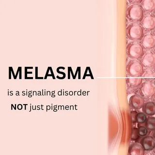 Brief knowledge of Melasma 
Follow for know more. 
#melasma #Melanocyte #Pigmentation #PigmentationT
