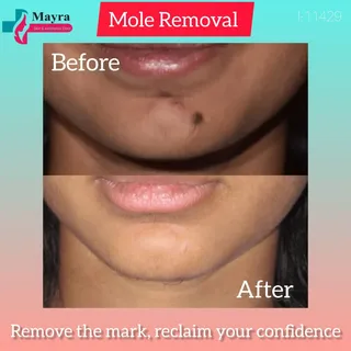 ✨ *Mole Removal Transformation* ✨
Check out the flawless before & after of our precise mole removal 