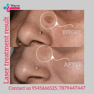 ✨ *Spot‑Free Skin with Laser* ✨
 See the amazing before & after of our laser treatment at *Mayra Ski