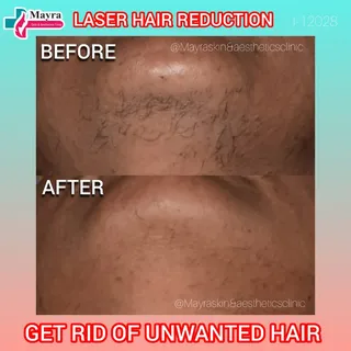 Tired of constant shaving/waxing? 
Before → After with our Laser Hair Reduction 💙 
Visible reductio
