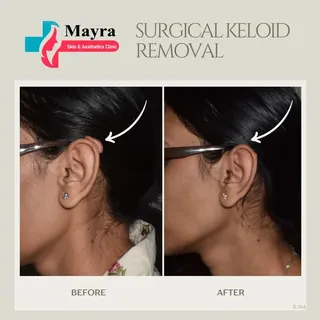 From keloid to clear ✨ Surgical keloid removal done right at Mayra Skin & Aesthetics Clinic.
Book y
