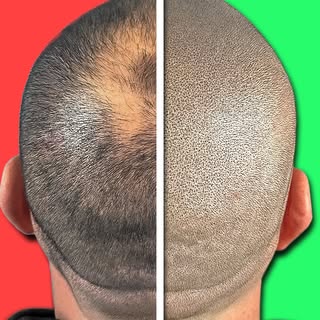 99% of people don’t realize this isn’t hair.

This is scalp micropigmentation - the best scalp micro