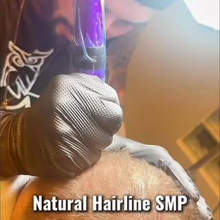 Scalp micropigmentation in progress at SMP Masters - the best scalp micropigmentation clinic in Long