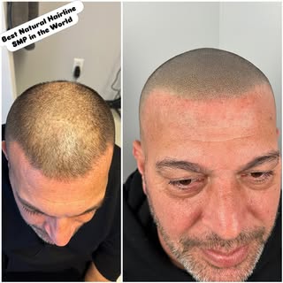Best Natural Hairline SMP in the World 🔥

Designing a natural hairline is the most difficult part o
