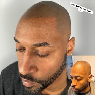 SMP touch up correction done right. We softened and feathered the hairline while fixing dark spots f