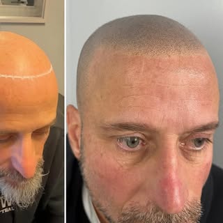Best Scalp Micropigmentation in New York - SMP Masters

Looking for the best SMP in New York or NYC?
