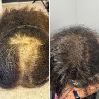 Women’s Density Fill SMP | SMP Masters

Looking for the best scalp micropigmentation for women in Ne