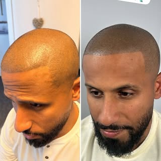 Best SMP Touch Up in New York 🗽 | SMP Masters

If your scalp micropigmentation has faded, turned bl