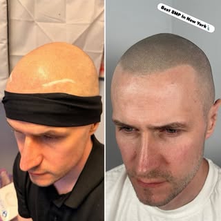 Natural hairline SMP + Beard SMP transformation by SMP Masters 🔥

No harsh barber lineup. No oversi