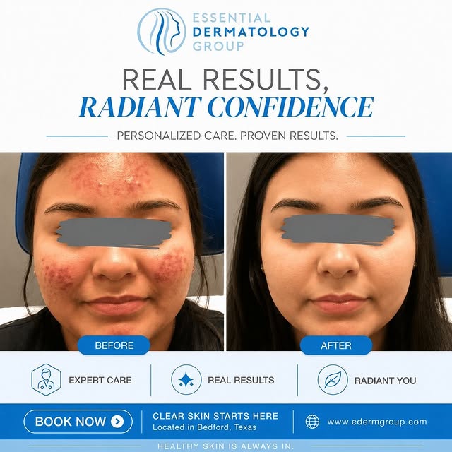 ✨ Real Results. Real Confidence. ✨

Acne doesn’t define you—and clear, healthy skin is possible with