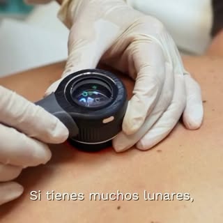 Si tienes varios lunares, piel clara o te has quemado con el sol, es importante que prestes atención