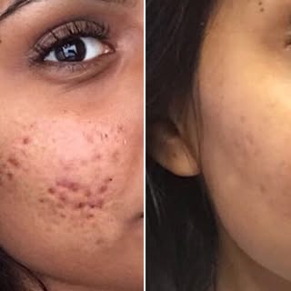 Acne & Acne Scars