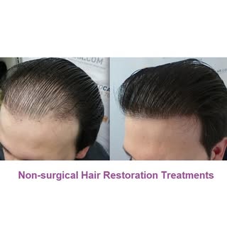 Non-surgical Hair Restoration Treatments