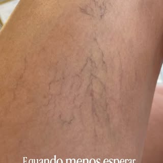 🦵✨ Enquanto menos se espera… suas pernas podem voltar a ser motivo de confiança!

Os microvasos pod