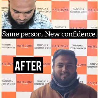Before ➡️ After ✨
Real transformation. Real confidence.
This is what a successful hair transplant lo