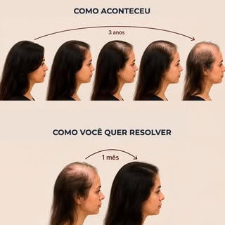 ✨ A alopecia androgenética não se resolve da noite para o dia.

Quando falamos em recuperação capila