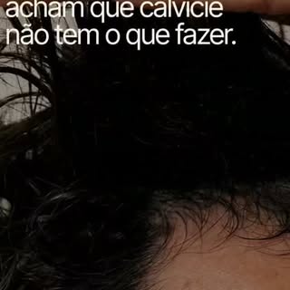 "Muitas pessoas ainda acreditam que a calvície não tem tratamento. Mas isso é um mito."

A alopecia 