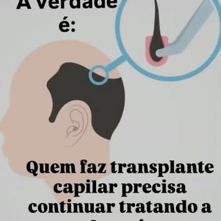O transplante capilar é um procedimento estético que redistribui os fios para áreas com menor densid
