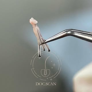Today we will tell you what a graft is ❓
 ⠀
 A hair graft is a medical term for a small piece of ski