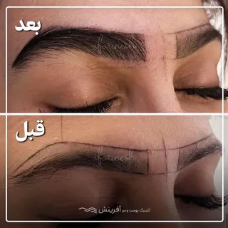 کاشت ابرو با تراکم بالا و خواب فوق العاده 
در کلینیک آفرینش 

#کاشت #کاشت_ابرو #کاشت_مو #کاشتابرو