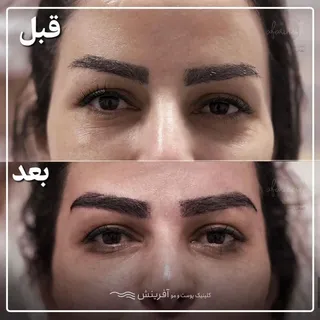کاشت ابروی فوق العاده 
با تراکم بالا و خواب طبیعی
برای زیبا جوی آفرینشی
#کاشت_ابرو #کاشت_تهران #کاشت