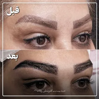یه قبل و بعد فوق العاده از کاشت ابروی 
زیباجوی عزیزمون در کلینیک آفرینش

قضاوت با شماست ✨
#کلینیک_کا